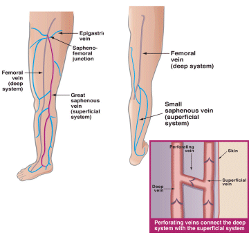 VNUS Closure Treatment